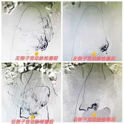 子宮肌瘤.jpg 子宮肌瘤.jpg